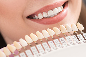 Dental Veneers