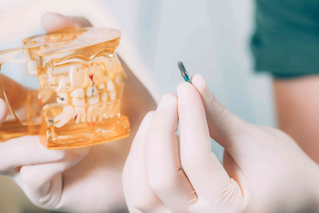 dental implants