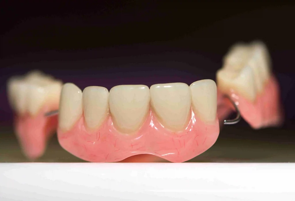 Dental Bridge Problem