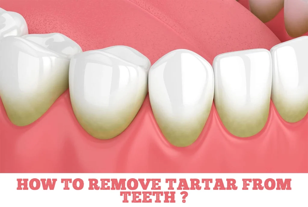 how to remove tartar from teeth