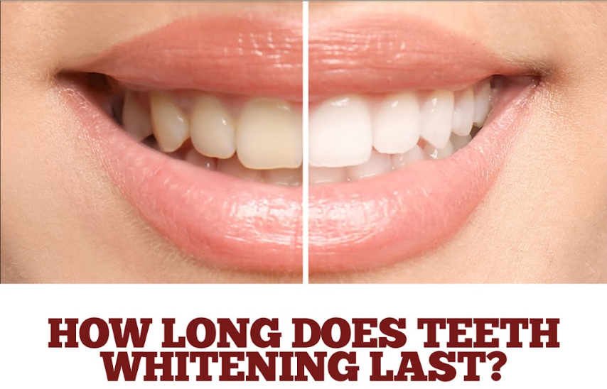 How-Long-Does-Teeth-Whitening-Last