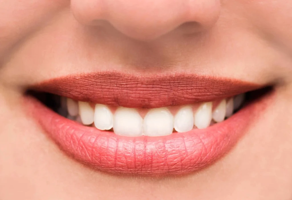 Teeth Bonding Vs Veneers