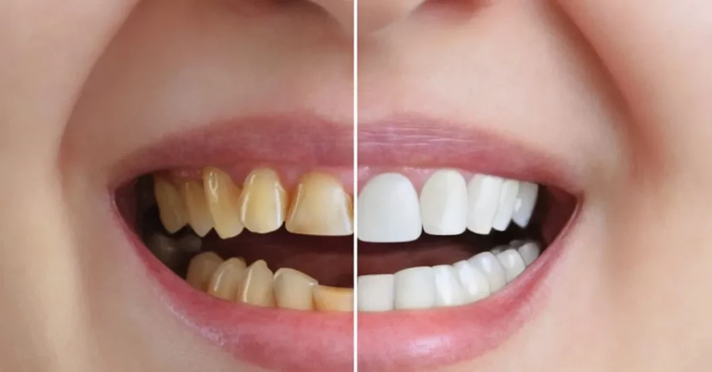 How Dental Crowns Can Give You a Smile Transformation