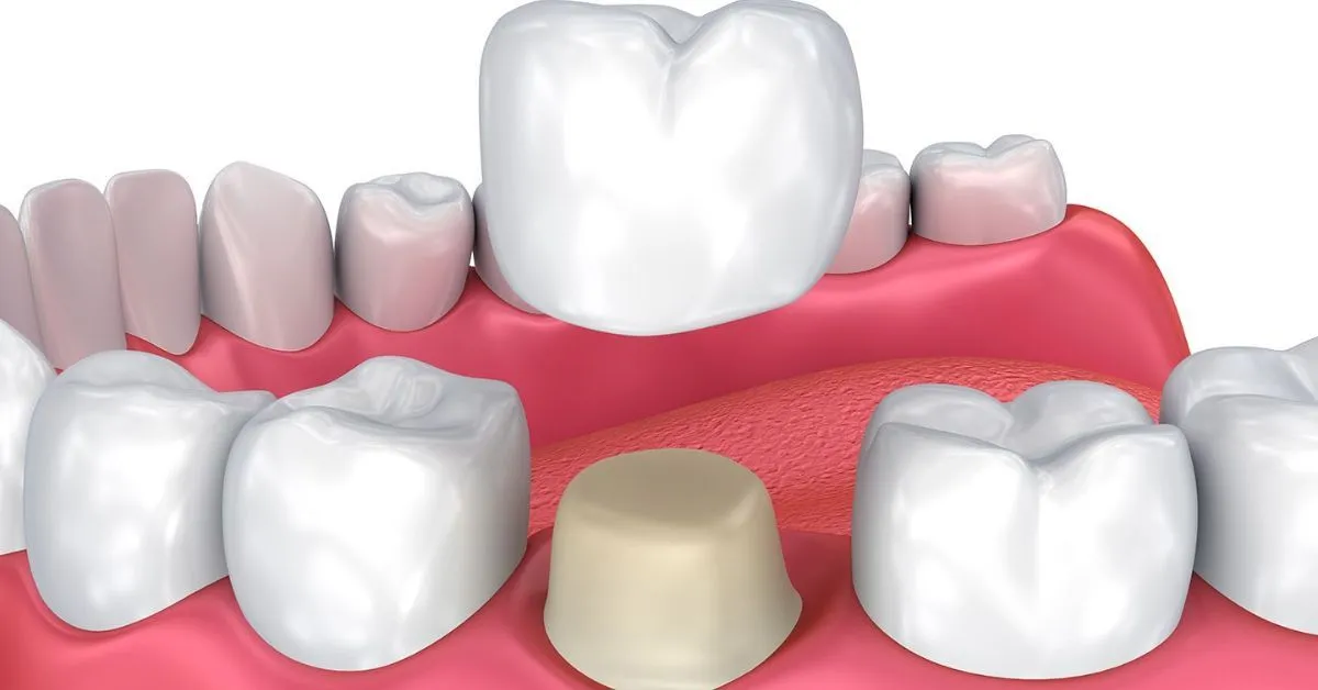 Types of Dental Crowns