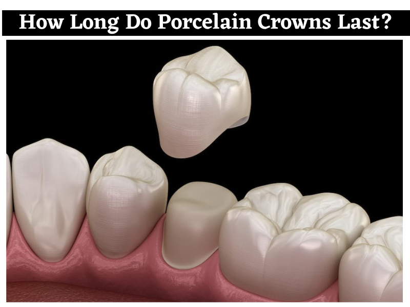 How Long Do Porcelain Crowns Last