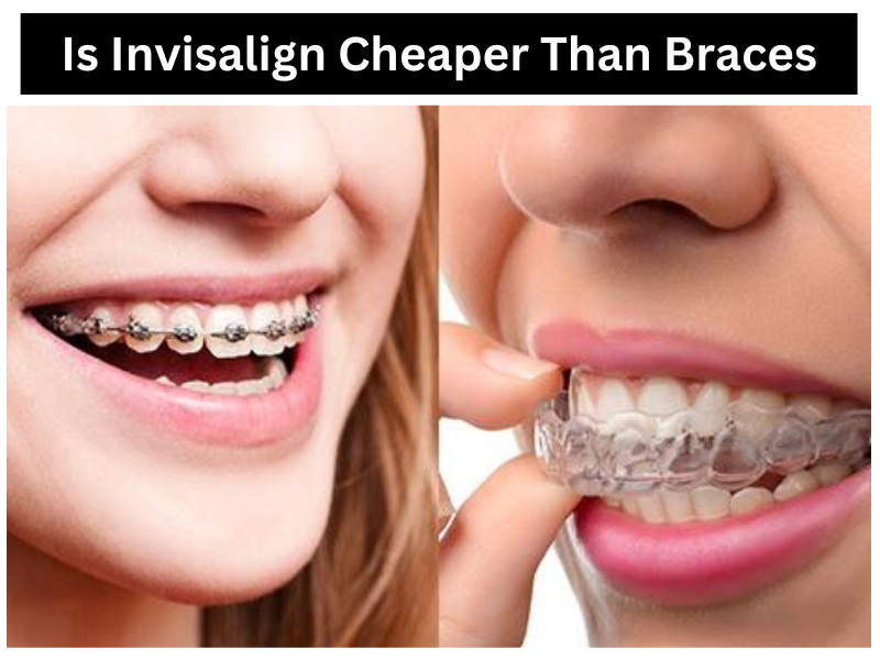 Is Invisalign Cheaper Than Braces