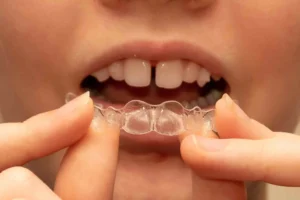 girl put on Invisalign for Gaps in Teeth