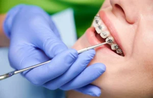 orthodontist placing braces on woman teeth