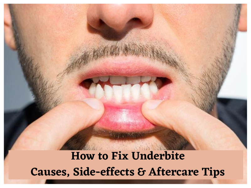 How to Fix Underbite Causes Side effects Aftercare Tips