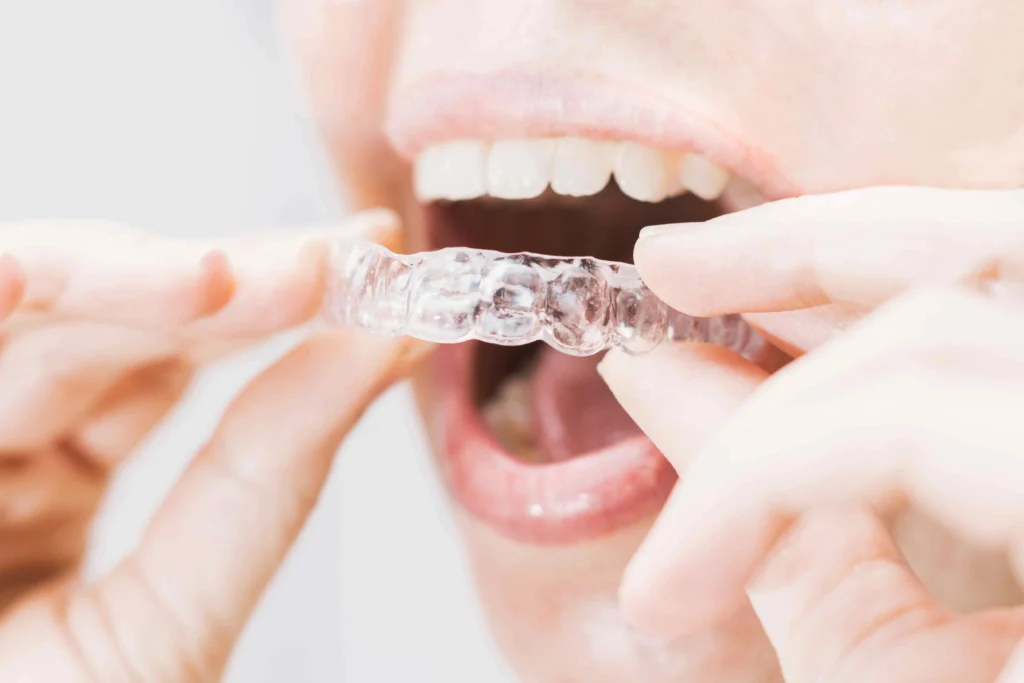 How to Fix an Overbite mouth with transparent Invisalign