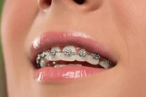 young woman with teeth braces