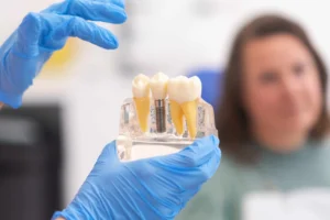 Should You Get Dental Implants