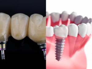 Dental Bridge vs. Implant