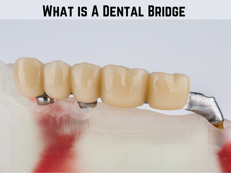 What is a Dental Bridge