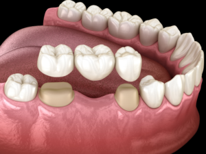 What is a Dental Bridge