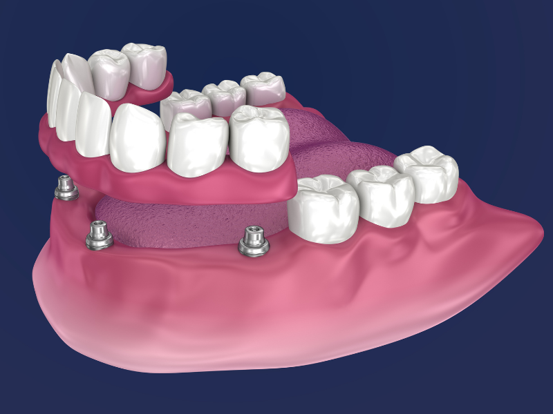 All-on-4 Dental Implants