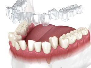 How Invisalign for Teen Works