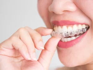 What is Invisalign for Teens