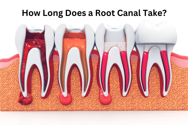 How Long Does a Root Canal Take