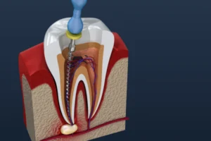 Root Canal Procedure