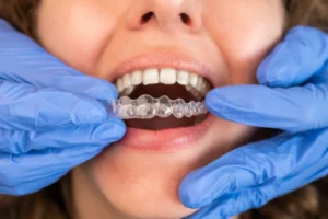 Insurance Cover Invisalign Treatment