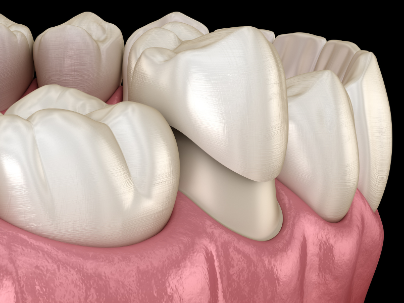 What are Dental Crowns