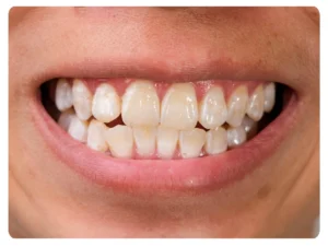 Preventing White Spots on Teeth