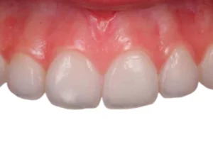 Treatment of White Spots on Teeth