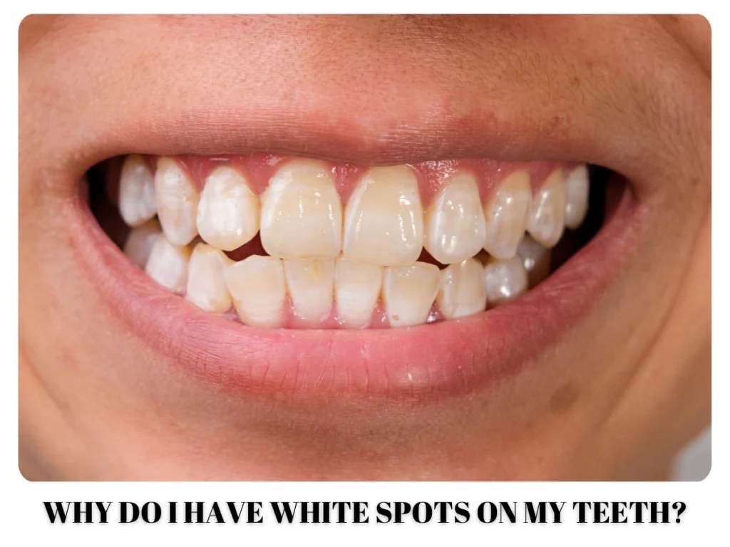 Why Do I Have White Spots on My Teeth