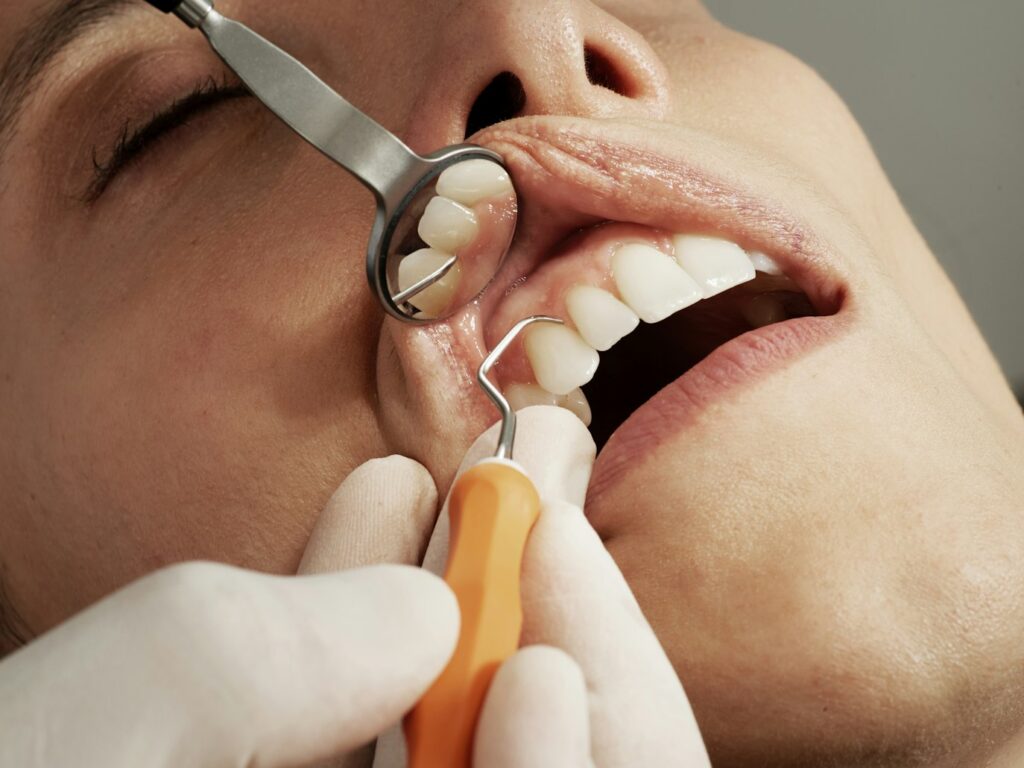 deep cleaning teeth